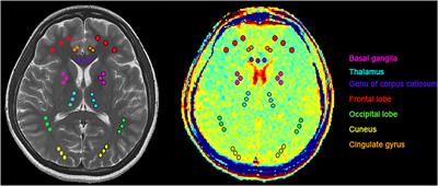 Imaging of glutamate in acute carbon monoxide poisoning using chemical exchange saturation transfer